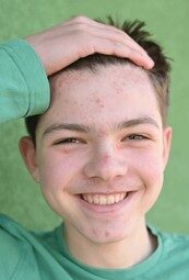 Acne-e1777369470144